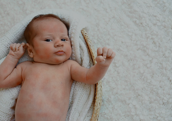 From Eczema To Asthma: What Eve...